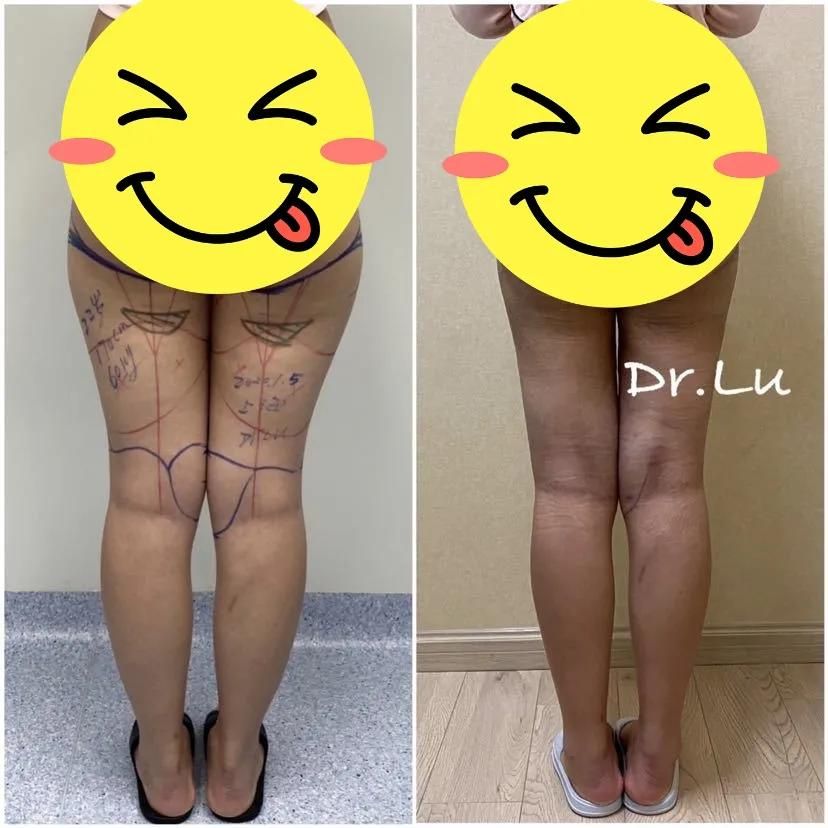 吸脂瘦腿效果怎样（吸脂和瘦腿针哪个瘦腿效果好？）-第5张图片