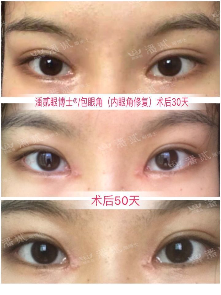 开内眼角危险吗（开内眼角过大有什么后果？）-第3张图片