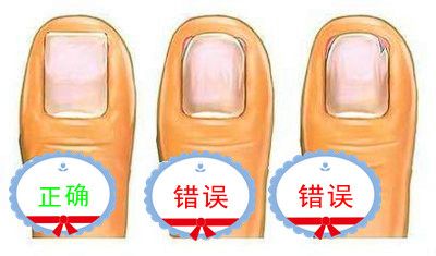 甲沟炎怎么办（甲沟炎的处理方法）-第5张图片