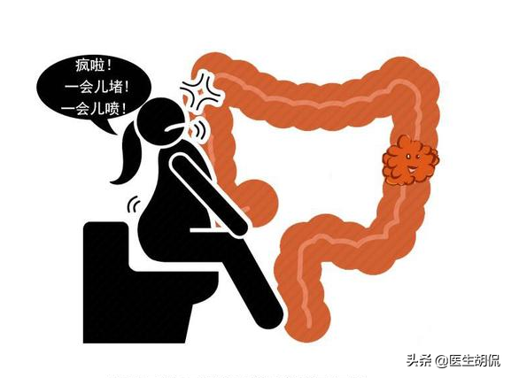 肠癌有什么症状？（大肠癌是什么症状 ？）-第2张图片