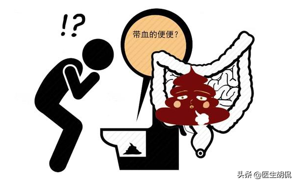 肠癌有什么症状？（大肠癌是什么症状 ？）-第3张图片