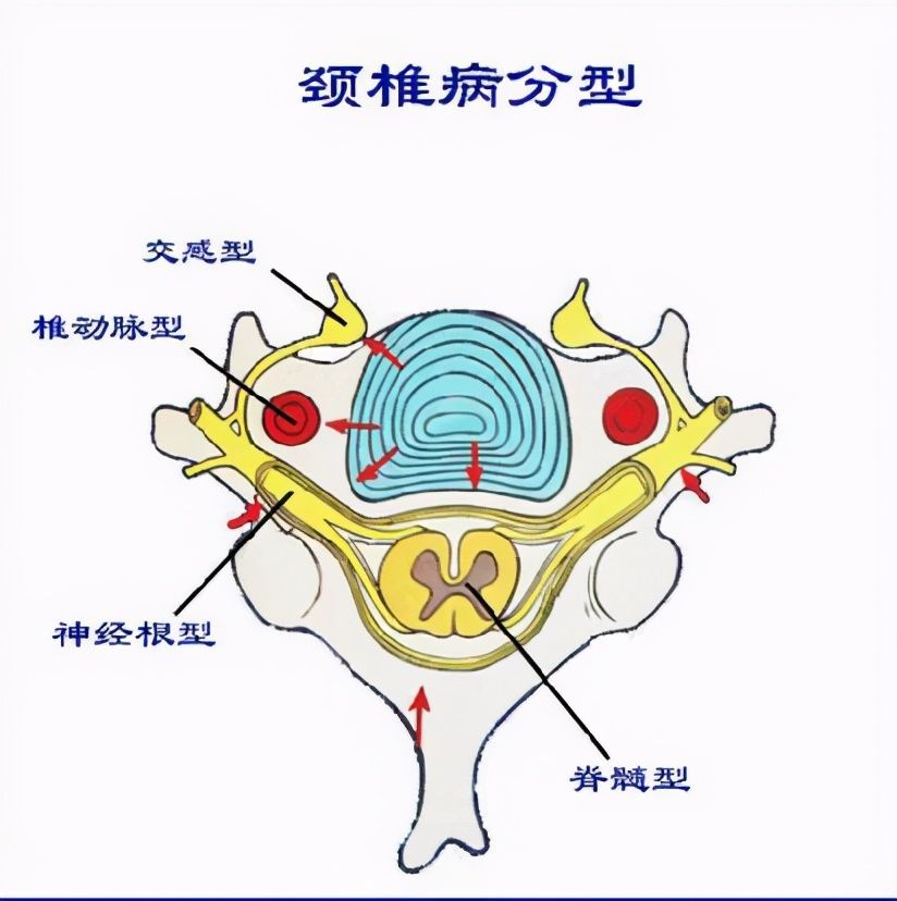 拔火罐能治颈椎病（拔火罐可以治疗颈椎病吗？）-第3张图片