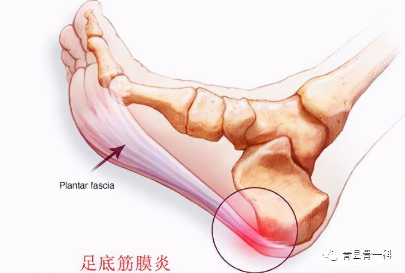脚底疼痛部位图解（脚底疼痛是怎么回事？）-第1张图片