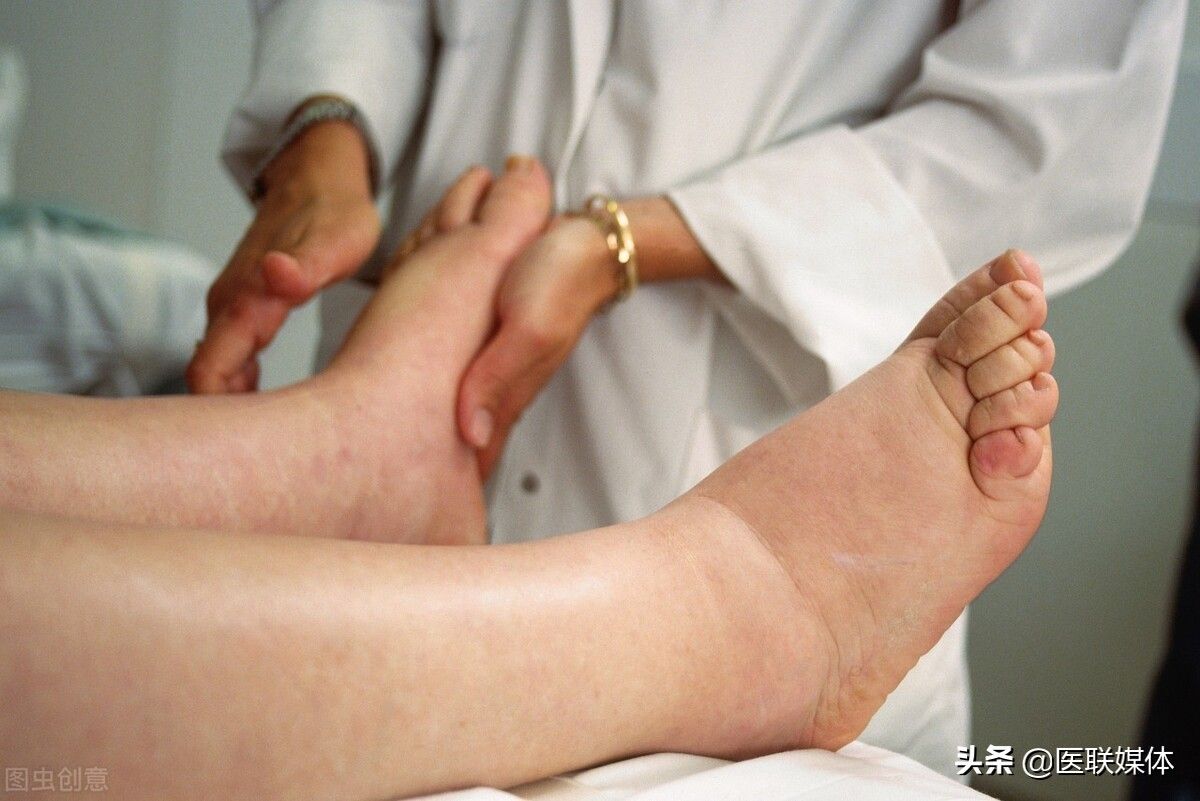 老人脚消肿的最快方法（老人双脚出现浮肿是什么原因？）-第1张图片