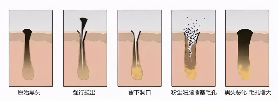 黑头是怎么形成的（黑头的形成）-第7张图片