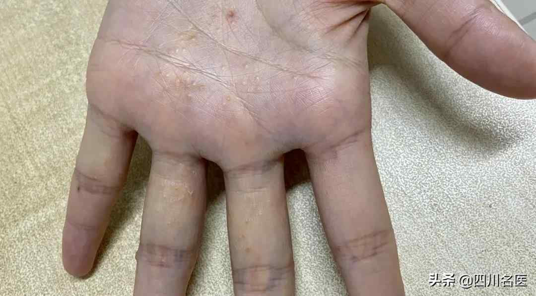 手指脱皮是什么原因（你的手为什么老脱皮？）-第2张图片
