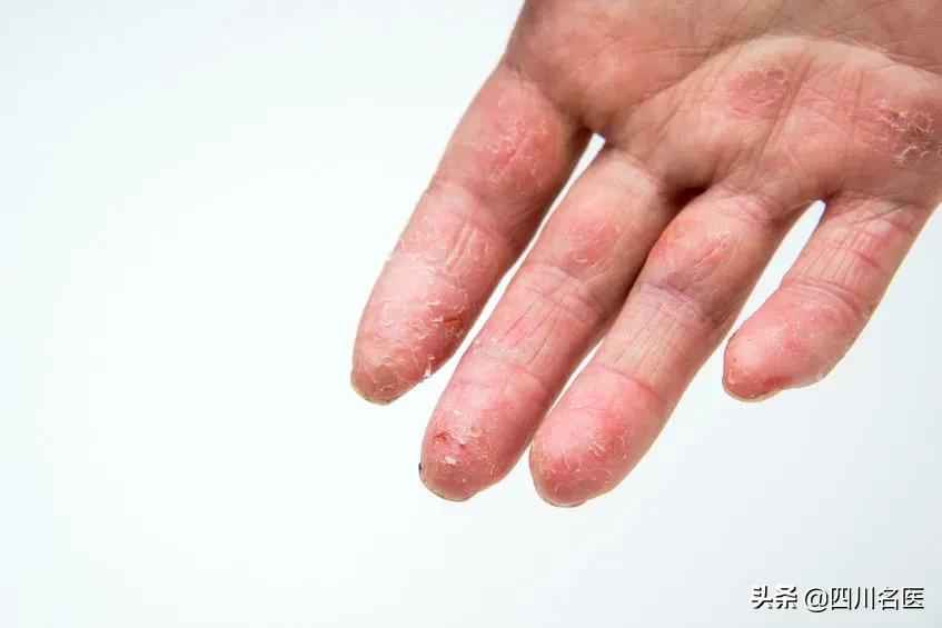 手指脱皮是什么原因（你的手为什么老脱皮？）-第1张图片