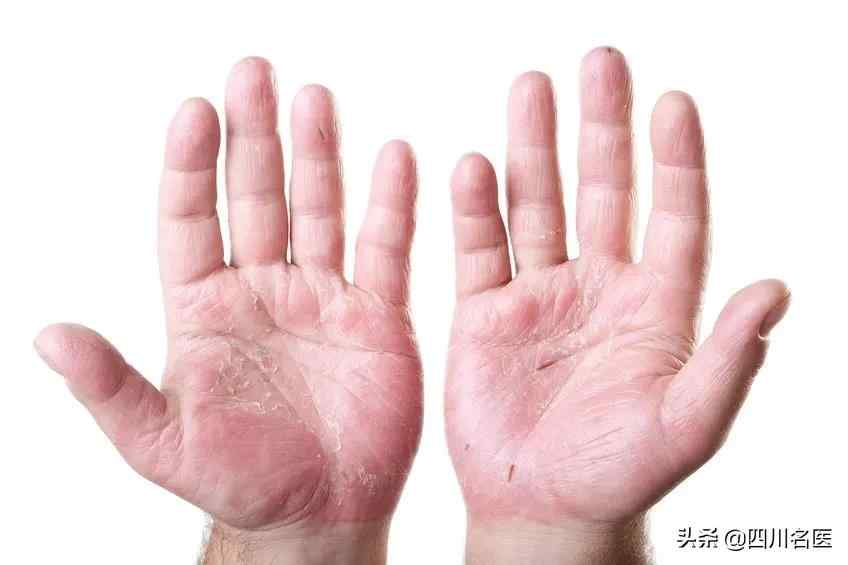 手指脱皮是什么原因（你的手为什么老脱皮？）-第7张图片