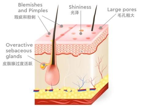 皮肤出油怎么办（皮肤爱出油怎么办？）-第3张图片