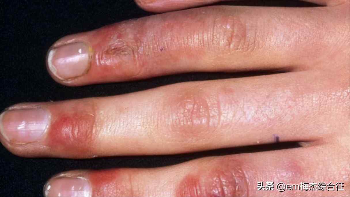 手冻了怎么办（冬天冻手了该怎么办？）-第8张图片