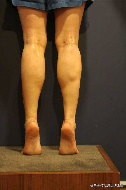 怎样使小腿变瘦（如何瘦小腿？）-第12张图片