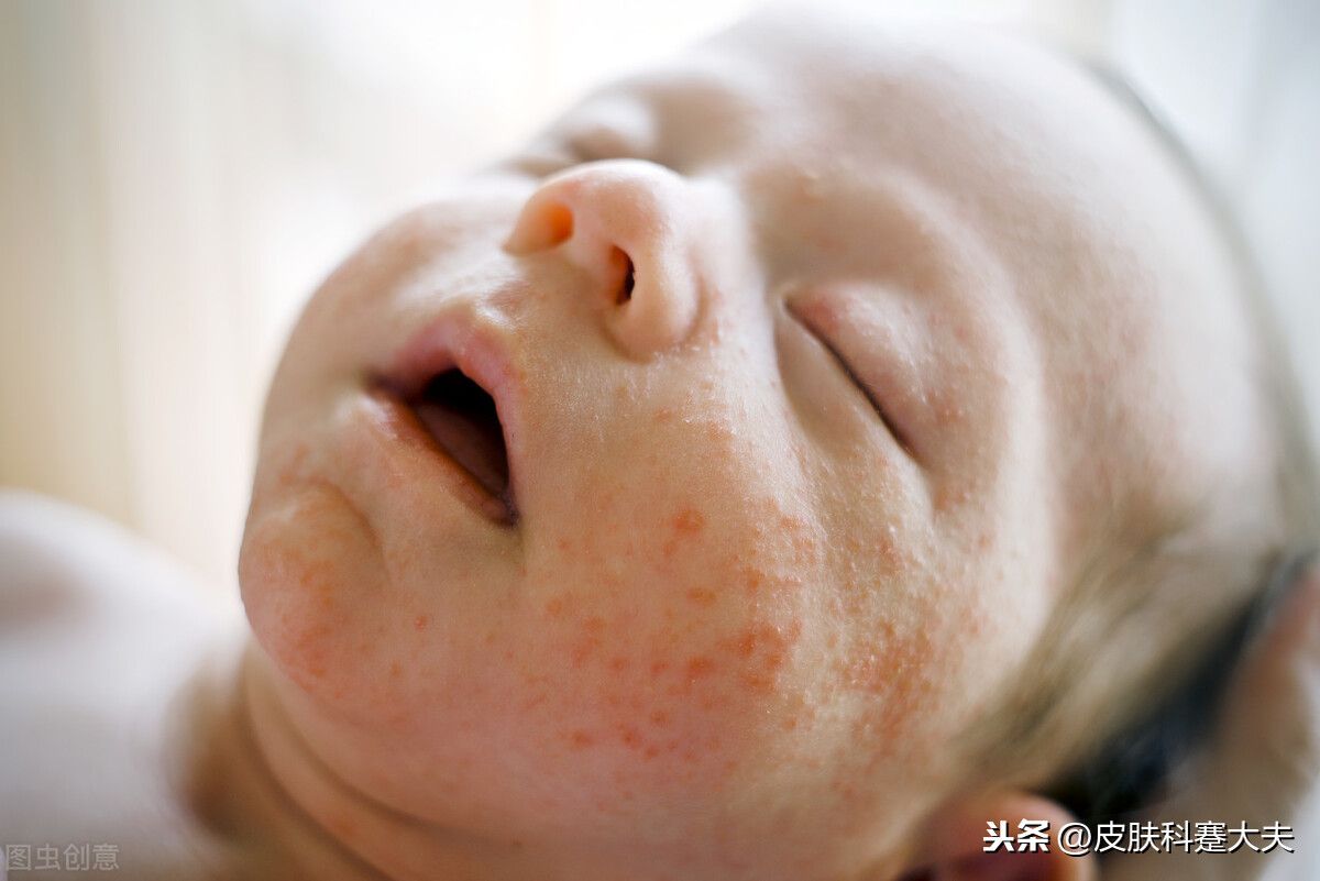 婴儿湿疹的原因（宝宝为什么会得婴儿湿疹？）-第1张图片
