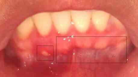 牙龈肿痛怎么快速消肿（牙龈肿痛如何快速消肿）-第2张图片