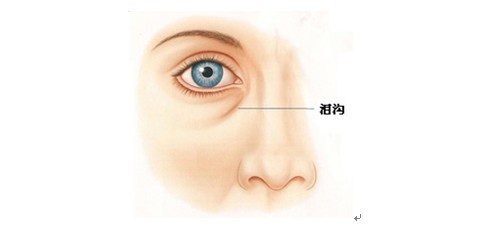 泪沟是什么！（什么是泪沟？）-第1张图片