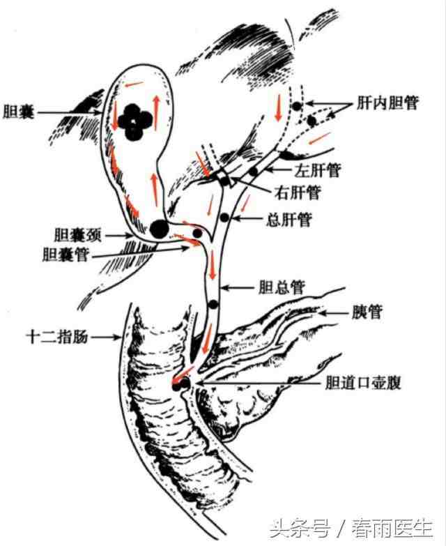 胆囊结石该怎么治疗（得了胆结石该如何治疗）-第1张图片