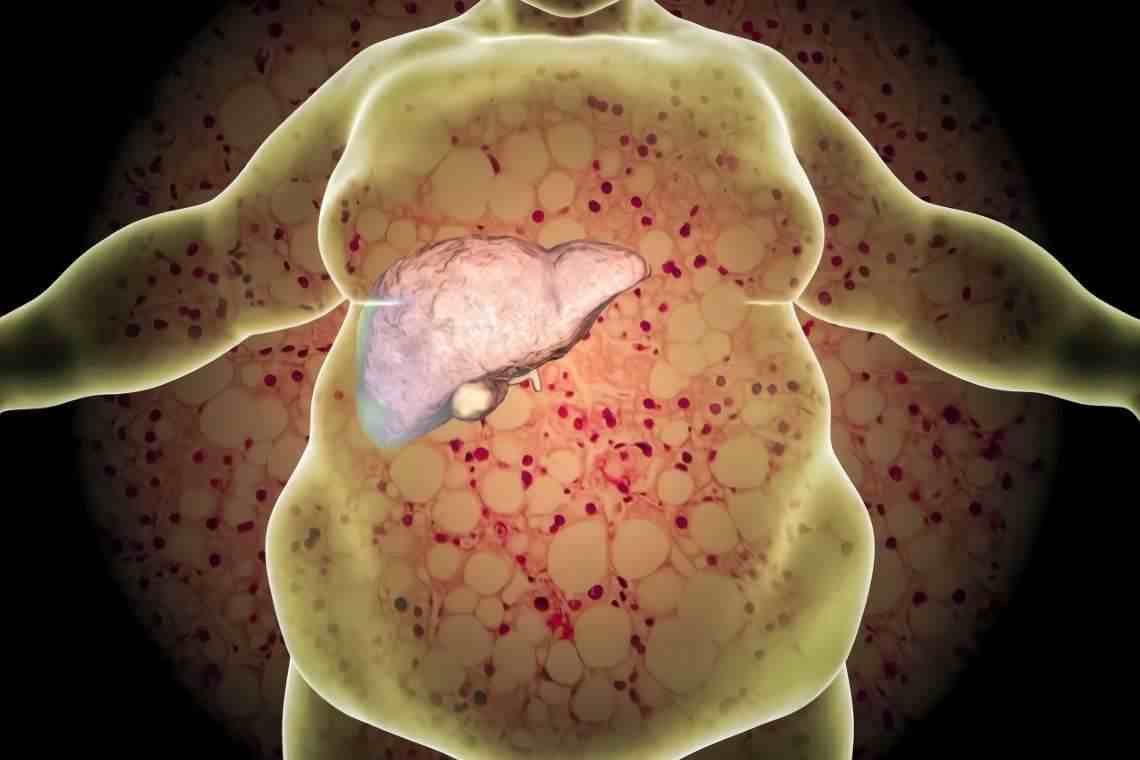 中度脂肪肝严重吗（轻度、中度、重度脂肪肝对于身体的危害有啥区别）-第3张图片