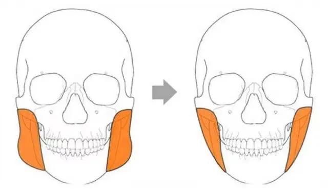 怎样去咬肌？（什么是去咬肌？）-第1张图片