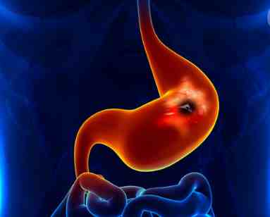 胃溃疡症状表现有哪些（胃溃疡的原因和危害分析）-第1张图片