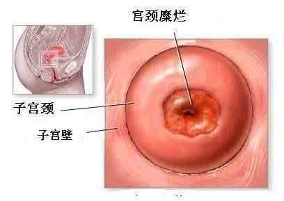 宫颈囊肿怎么处理（子宫宫颈囊肿怎么办）-第2张图片