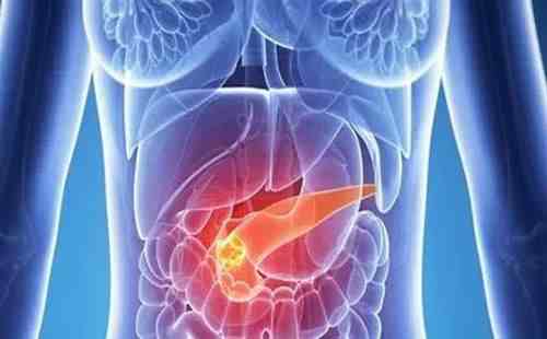 胰腺癌是怎么引起的（常见的诱发胰腺癌因素有哪些）-第1张图片