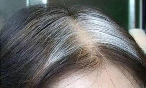 头上白发越长越多的原因是什么?-第1张图片 头上白发越长越多的原因是什么?-第1张图片