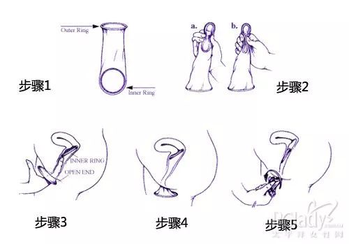 避孕栓的使用方法图解（女用避孕套使用方法图解）-第2张图片