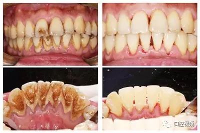 一个牙医的良心忠告(洗牙受不了只洗了一半)-第1张图片