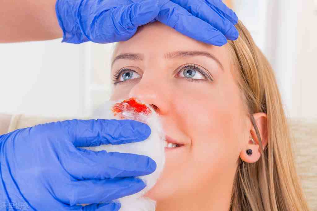 流鼻血是什么原因（鼻子出血是如何引起的）-第1张图片