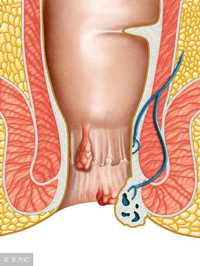 痔疮会传染吗（痔疮会传染给他人吗）-第1张图片