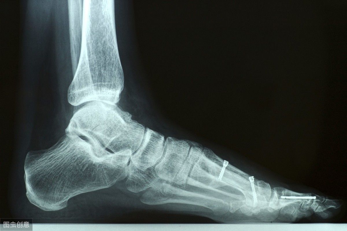 脚后跟骨刺的治疗方法（足跟骨刺的治疗方法）-第1张图片