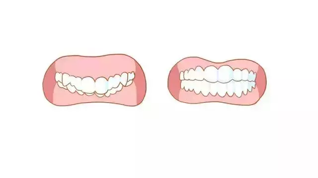 牙齿矫正图（牙齿矫正对颜值有多大影响）-第5张图片