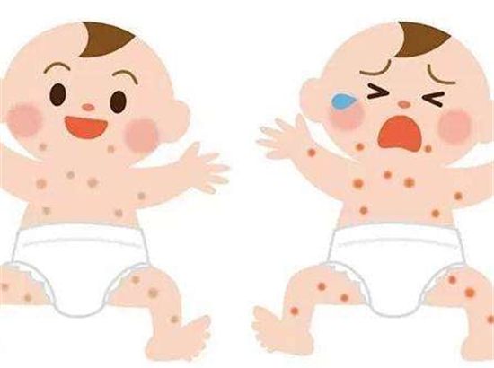 幼儿湿疹治疗（治疗宝宝的湿疹攻略）-第2张图片