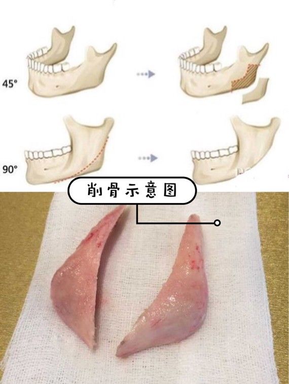 削骨手术过程是怎样的（ 神秘的“磨骨”手术）-第2张图片