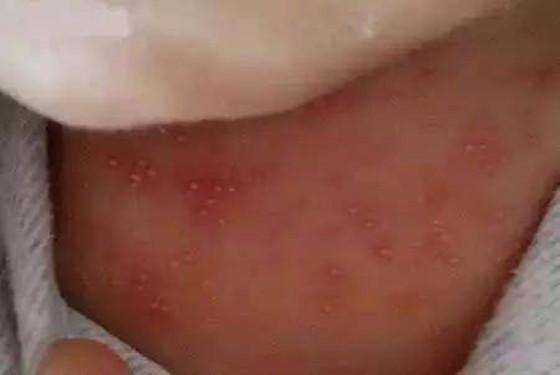 湿疹和热疹的区别图片（湿疹和热疹的区）-第3张图片