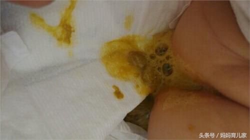 宝宝发烧腹泻（宝宝发烧腹泻的症状）-第1张图片