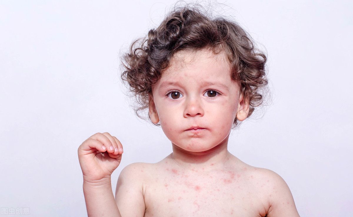 过敏性荨麻疹的治疗（荨麻疹的简单又根治的方法）-第2张图片