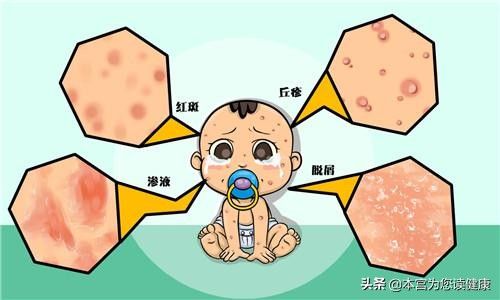 小儿湿疹图片（宝宝为什么会长湿疹？）-第1张图片