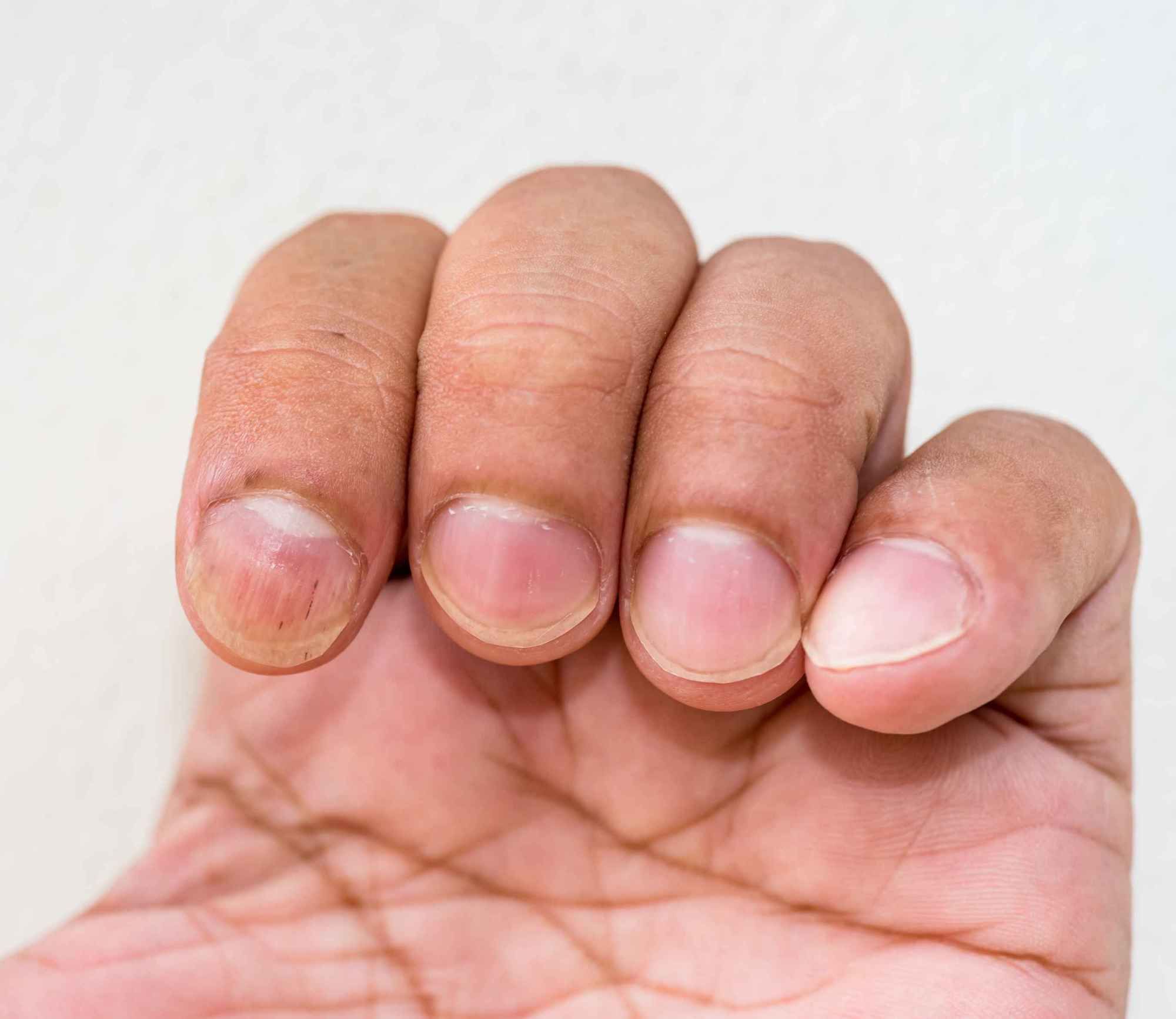 手指甲上的月牙（人指甲上为什么会有白色的月牙？）-第3张图片