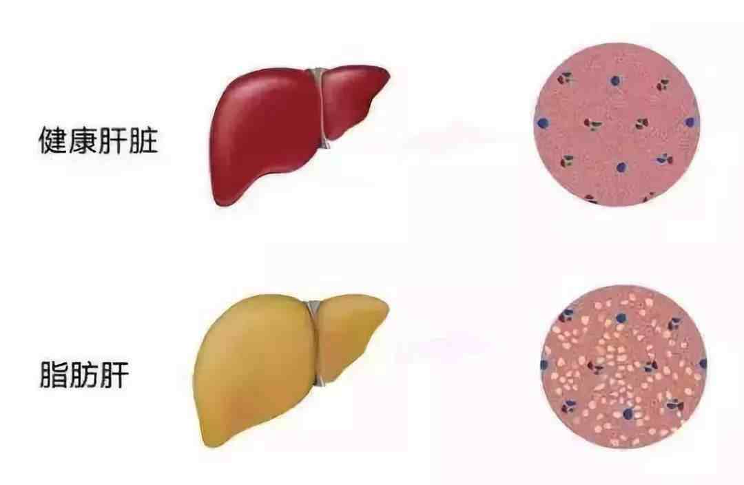 中度脂肪肝严重吗（轻度、中度、重度脂肪肝对于身体的危害有啥区别）-第4张图片
